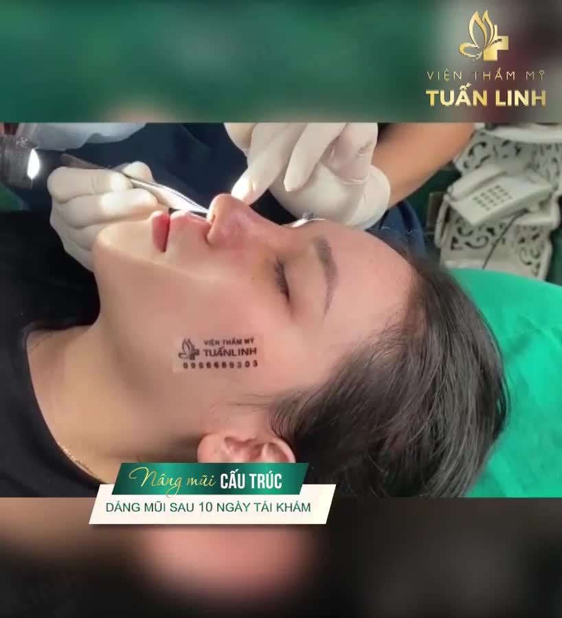 NÂNG MŨI CẤU TRÚC - KẾT QUẢ SAU 10 NGÀY TÁI KHÁM