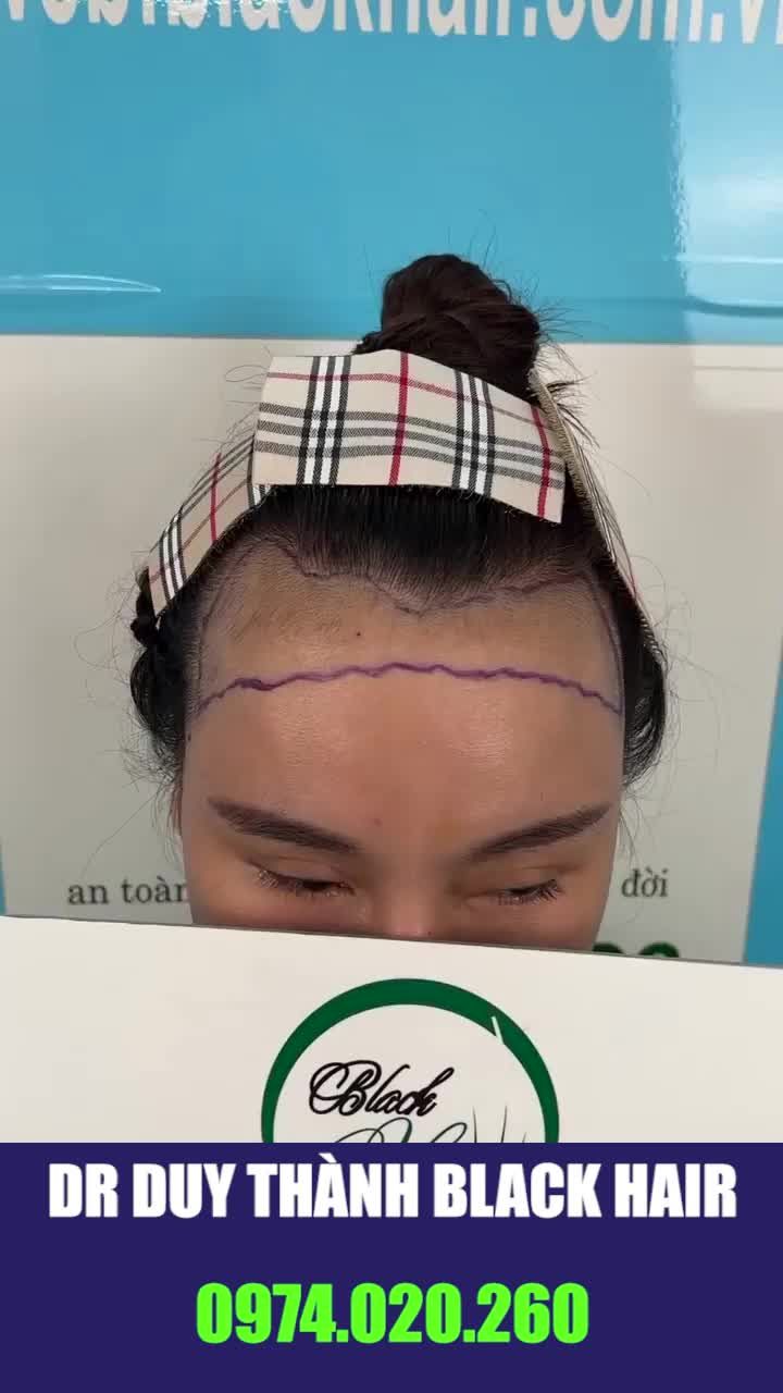Cấy tóc nữ đây nhé