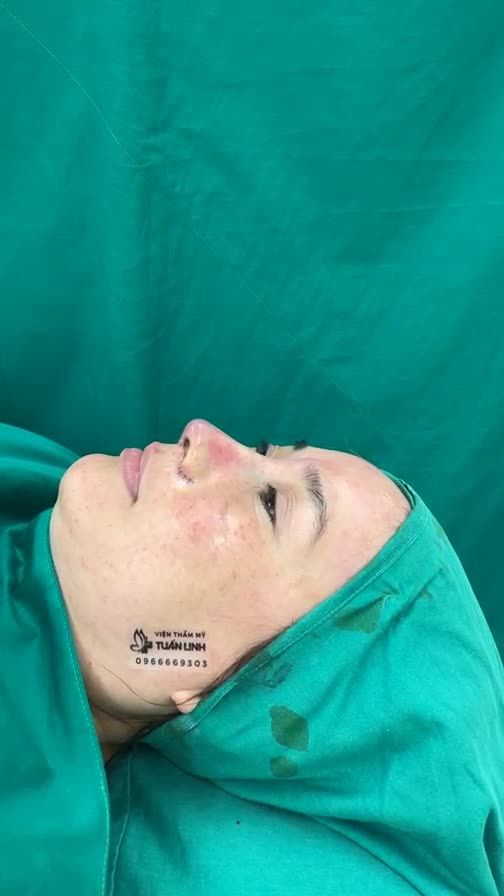 Case Nâng mũi sửa lại sụn Surgiform cho chị gái đến từ Hàn Quốc