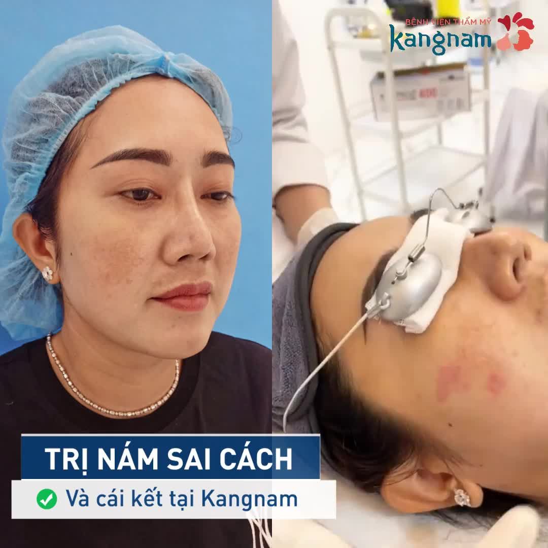 Lúc nám nó lan ra chị lo lắm, xong bạn chị khuyên đến bệnh viện. Nghe bác sỹ tư vấn với thăm khám thì nhẹ lòng hẳn, giờ cứ theo liệu trình mà trị thôi