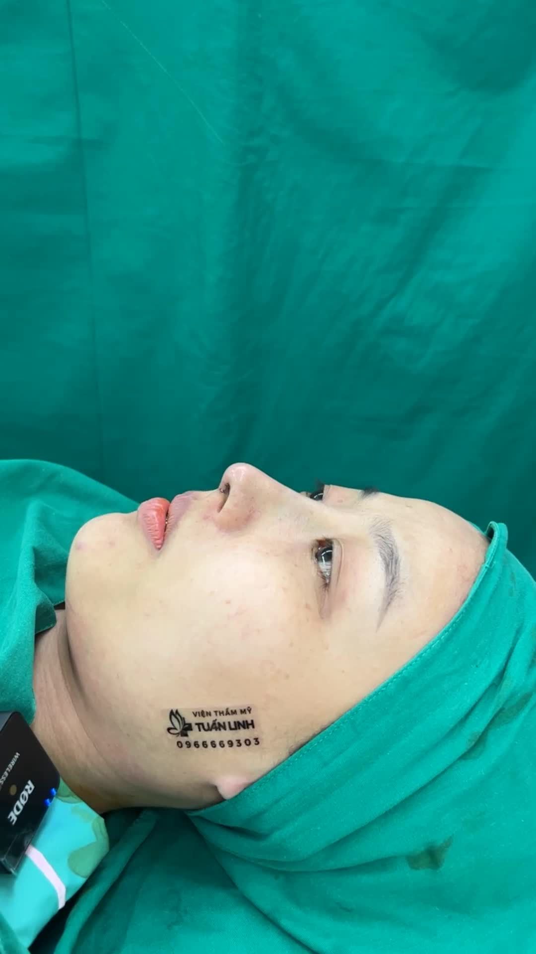 Case Nâng mũi cấu trúc Surgiform sau 90 phút phẫu thuật
