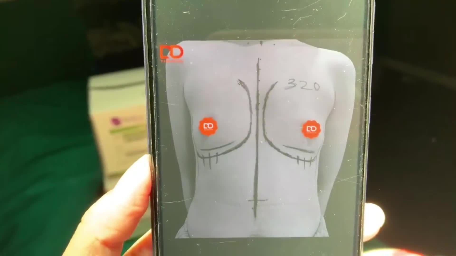 KẾT QUẢ SAU 60 PHÚT PHẪU THUẬT CỦA CA NGỰC ỨC GÀ