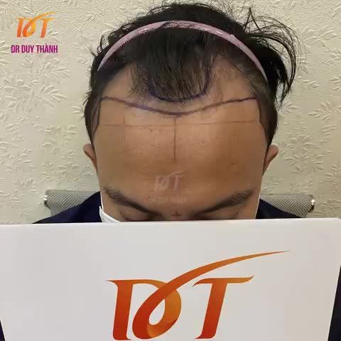 VIDEO KẾT QUẢ CẤY 2150 NANG TÓC CHO BẠN NAM ĐẾN TỪ ĐÀ NẴNG (NGÀY HÔM QUA)