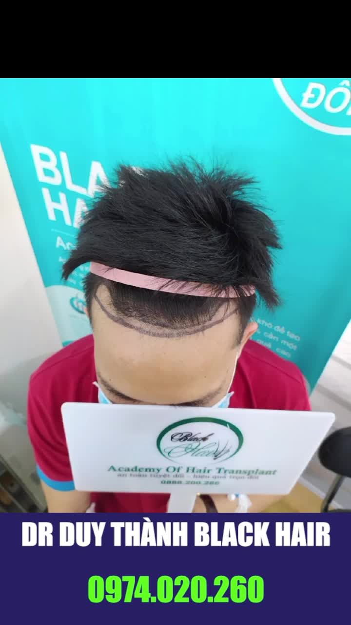 Dịch vụ cấy tóc của Dr Duy Thành