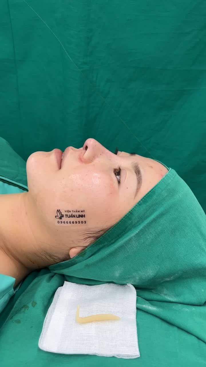 Case Nâng mũi cấu trúc sửa lại sụn Surgiform cho chị gái đến từ Hậu Giang