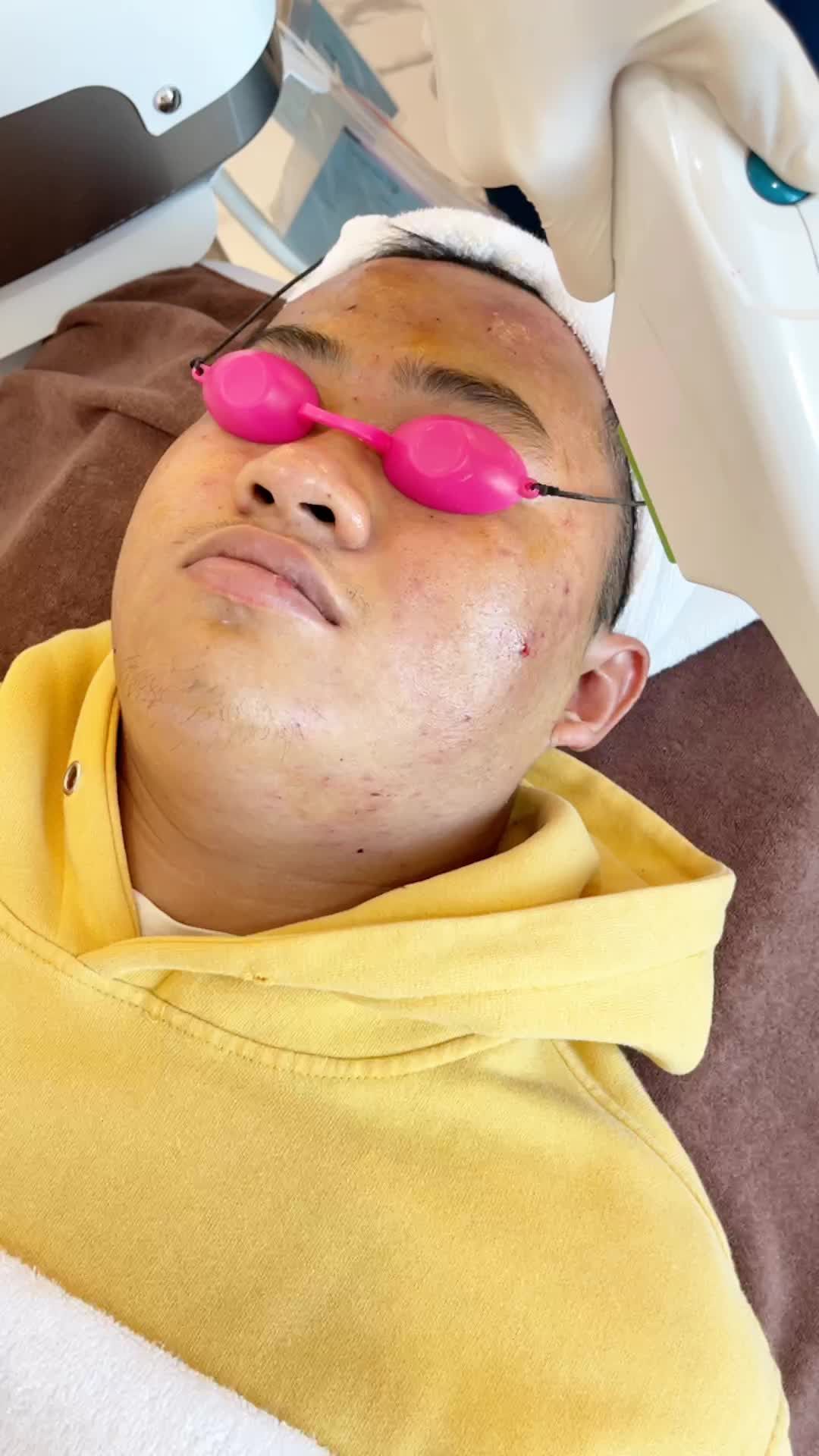 Điều trị mụn bằng công nghệ Deacne hiệu quả cùng Kangnam