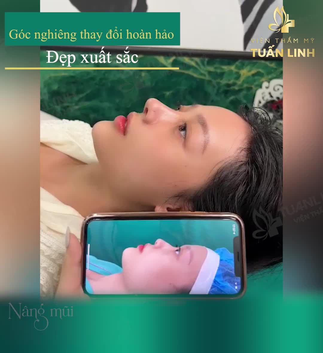 NÂNG MŨI SIÊU CẤU TRÚC 35TR ( giá gốc 60TR)