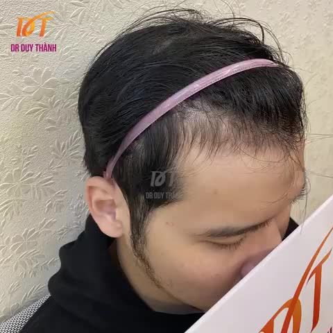 VIDEO FULL KO CHE - KQ CẤY 1300 NANG TÓC NÉT CĂNG CHO BẠN NAM VUI TÍNH NGÀY HÔM QUA.