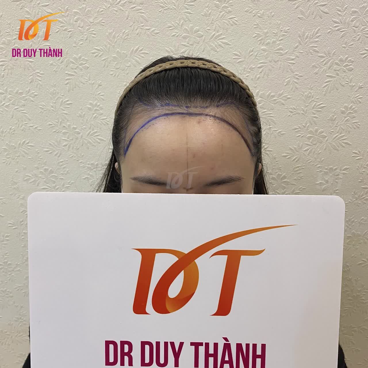 CẤY TÓC NỮ - KẾT QUẢ CẤY 1300 NANG TÓC KHẮC PHỤC TRÁN CAO BẨM SINH CHO BẠN NỮ XINH ĐẸP NGÀY HÔM QUA Ạ.