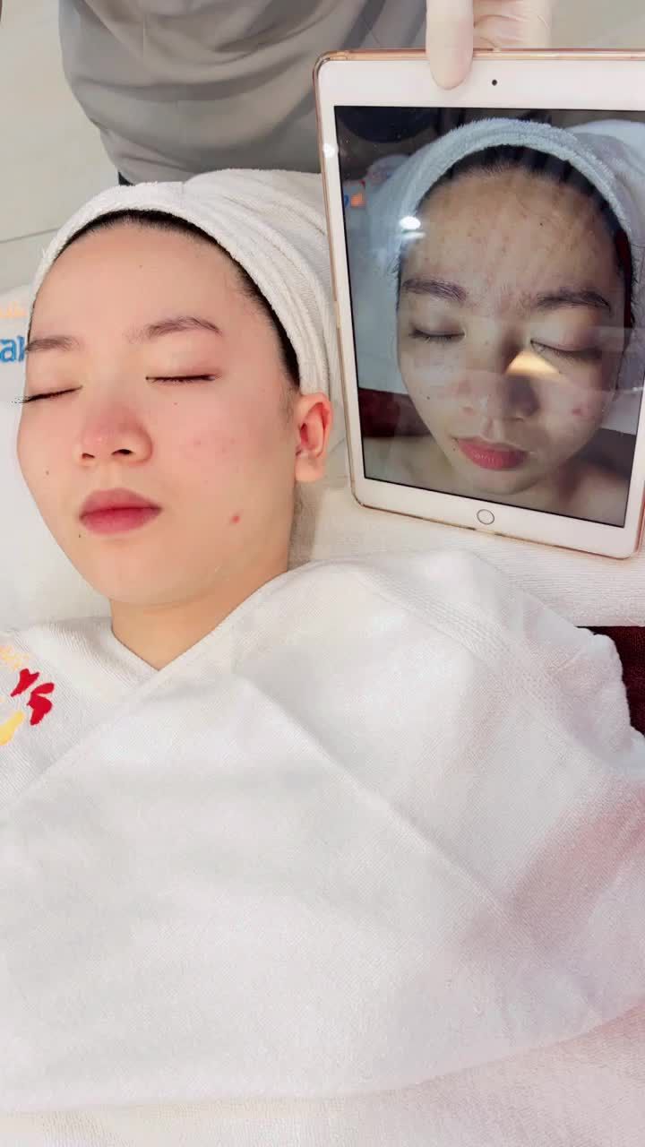 Kết quả điều trị mụn hiệu quả với Công nghệ De-acne tại Kangnam