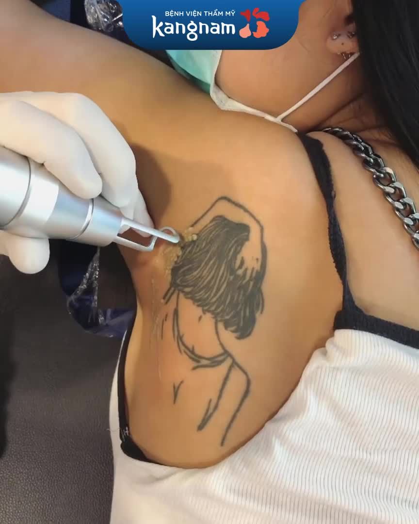 Laser Picosure - Xóa đến đâu sạch xăm đến đấy