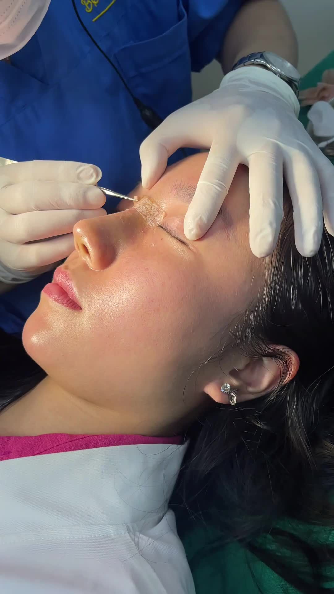 Dáng mũi cực đẹp chỉ sau 7 ngày nâng mũi Surgiform