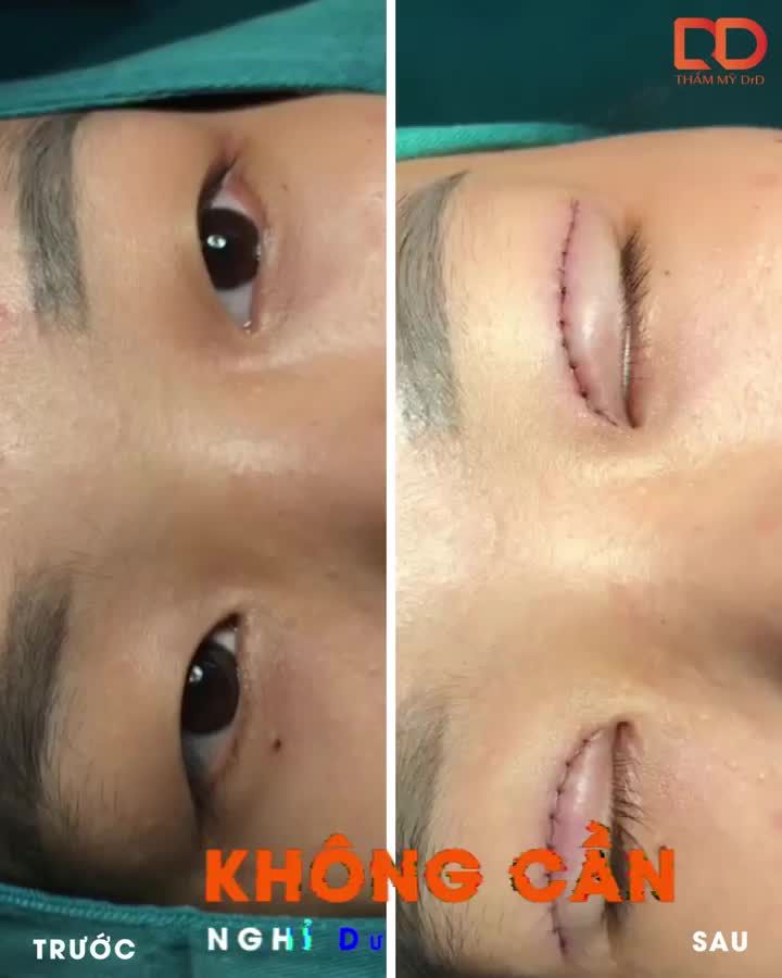 Không có một công thức chuẩn nào cho bất kì phương pháp cắt mí nào cả.