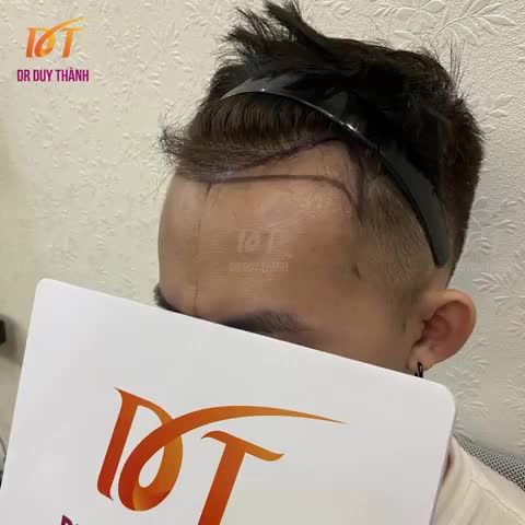 TRƯỚC VÀ NGAY SAU KHI CẤY 1425 NANG TÓC KHẮC PHỤC HÓI CHỮ M VÀ HÓI ĐỈNH CHO HOTBOY ĐẤT CẢNG.