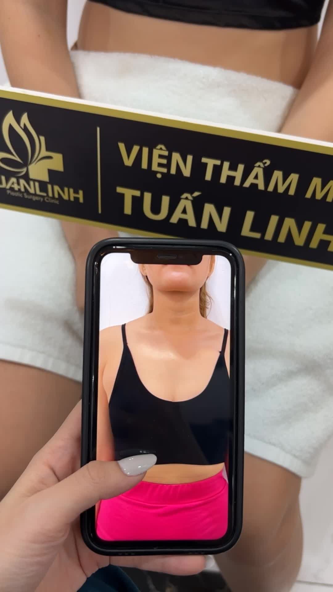 Nâng V1 tái khám sau 14 ngày