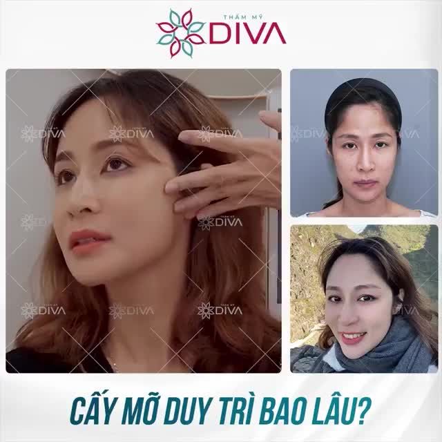 KẾT QUẢ SAU CẤY MỠ DUY TRÌ BAO LÂU