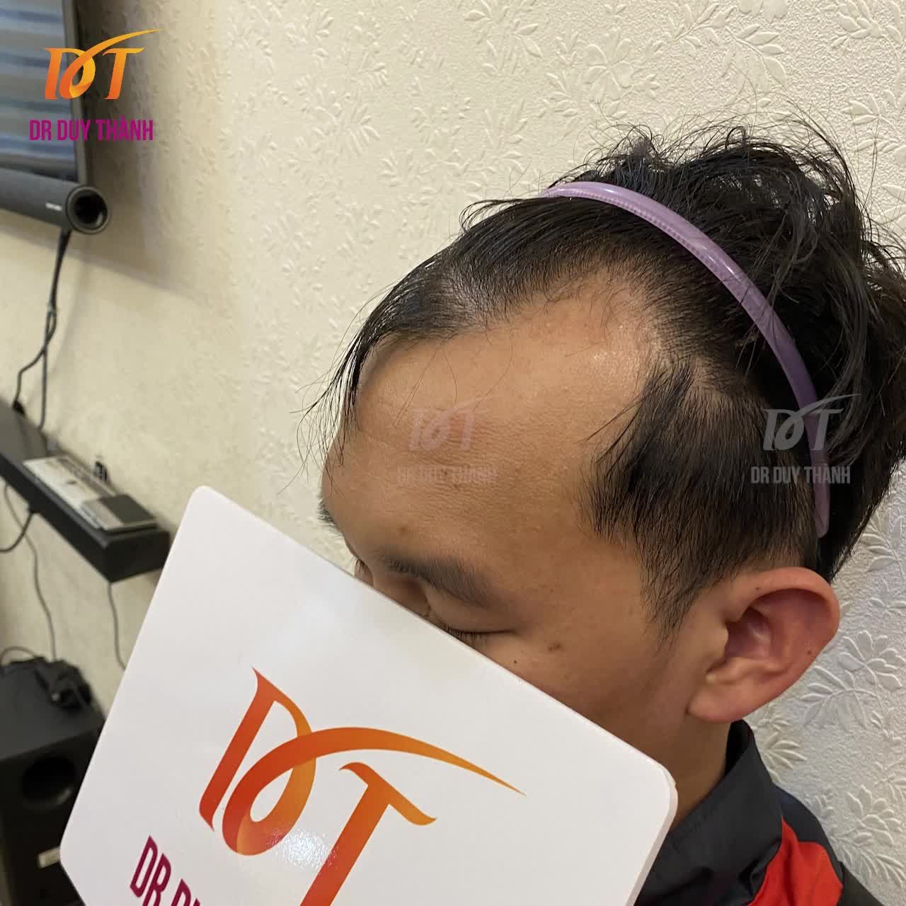 LÊN VIDEO 1600 NANG TÓC CẤY HÔM TRƯỚC CHỮA HÓI CHỮ M, GỬI ANH EM CÙNG XEM Ạ.