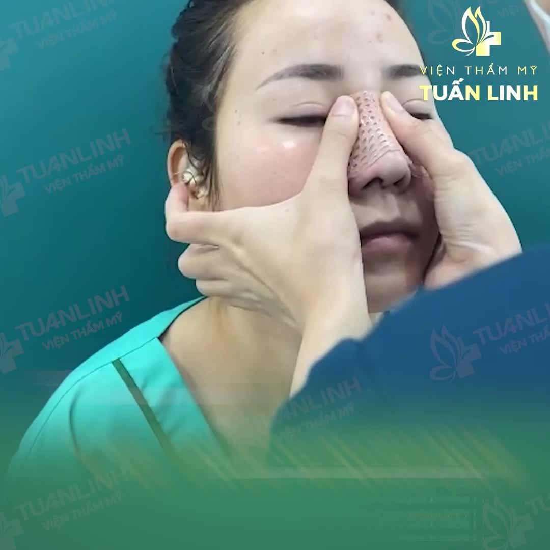 ANGEL LINE TỰ NHIÊN - Dáng mũi thanh tú cho cô nàng thích nét đẹp nhẹ nhàng