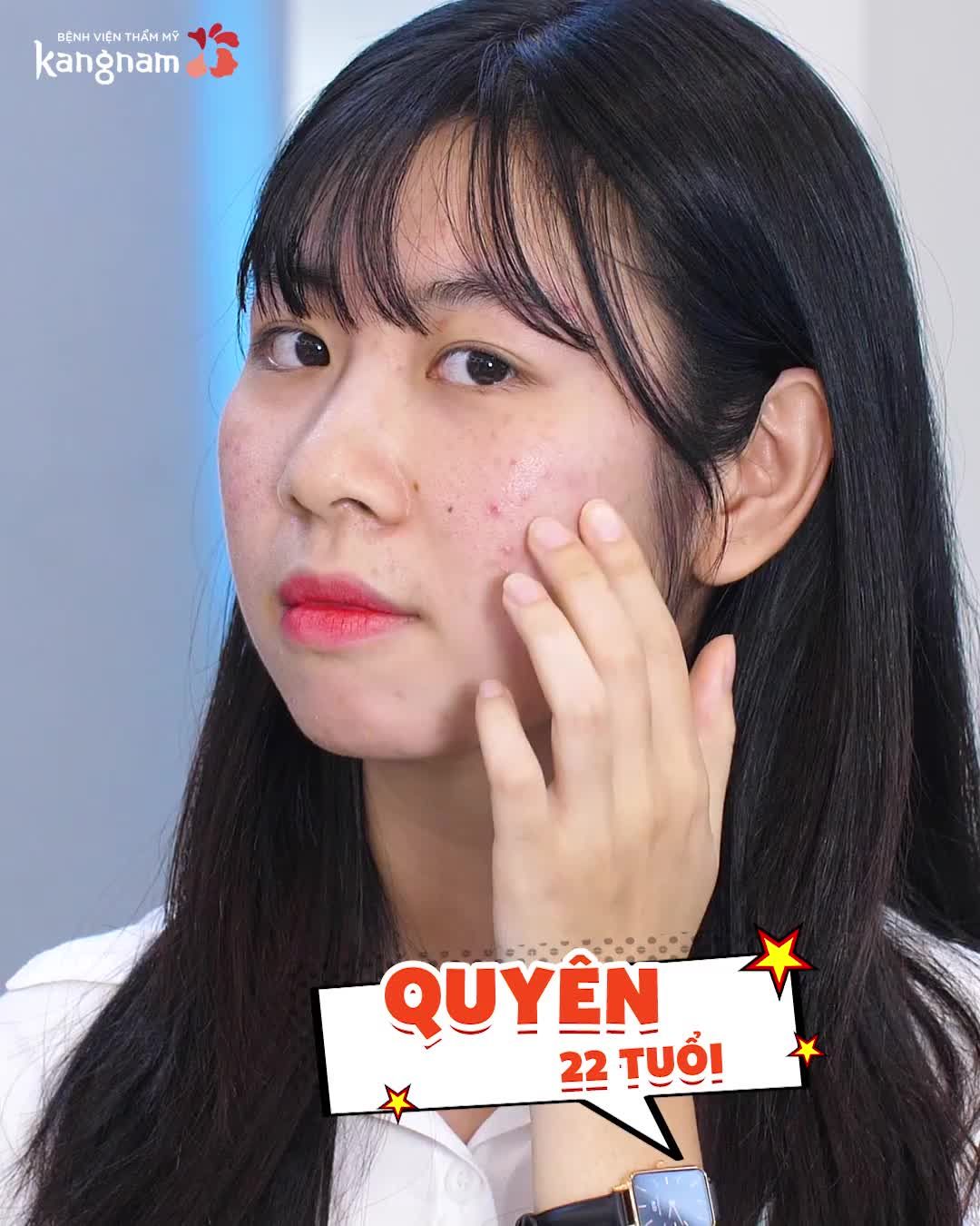 Bị đặt biệt danh là MẶT MỤN khiến tớ tự ti và mặc cảm cực kì