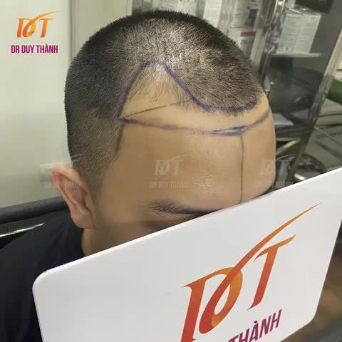 Lên video cấy tóc 1750 nang cho bạn nam đến từ Bình Phước mời anh em cùng chiêm ngưỡng.