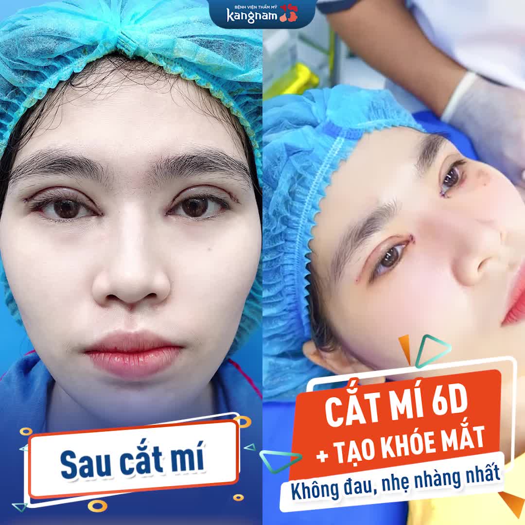 CẬN CẢNH QUY TRÌNH CẮT MÍ MẮT BẰNG CÔNG NGHỆ PLASMA TIÊN TIẾN HIỆN NAY