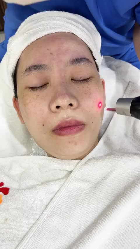 Điều trị tàn nhang bằng Laser Picosure tại Kangnam