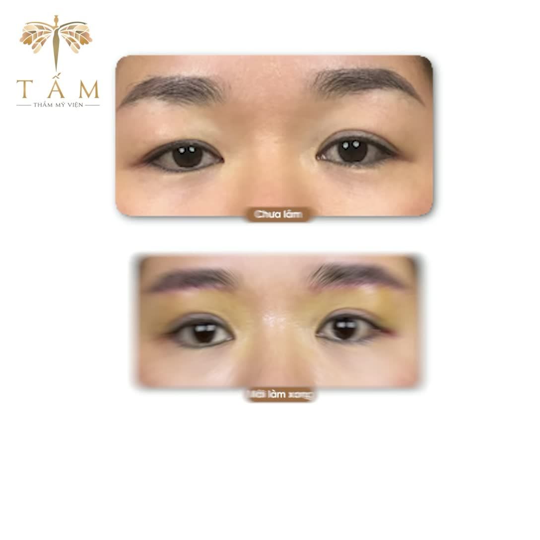 Nâng cung mày trẻ hoá đôi mắt
