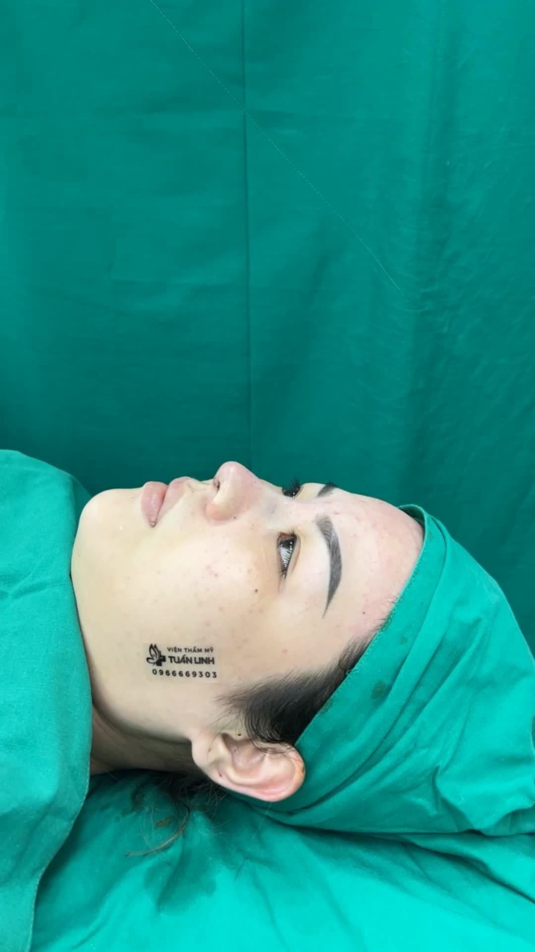 Case Nâng mũi cấu trúc hoàn thành sau 90 phút.