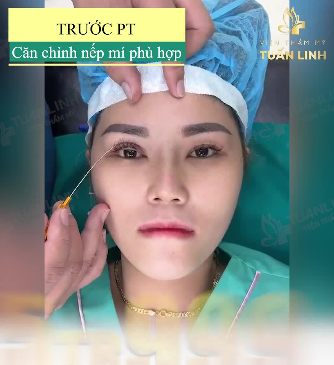 CẮT MÍ PLASMA - 5TR999 - KHÔNG SƯNG ĐAU - ĐẸP TỰ NHIÊN.