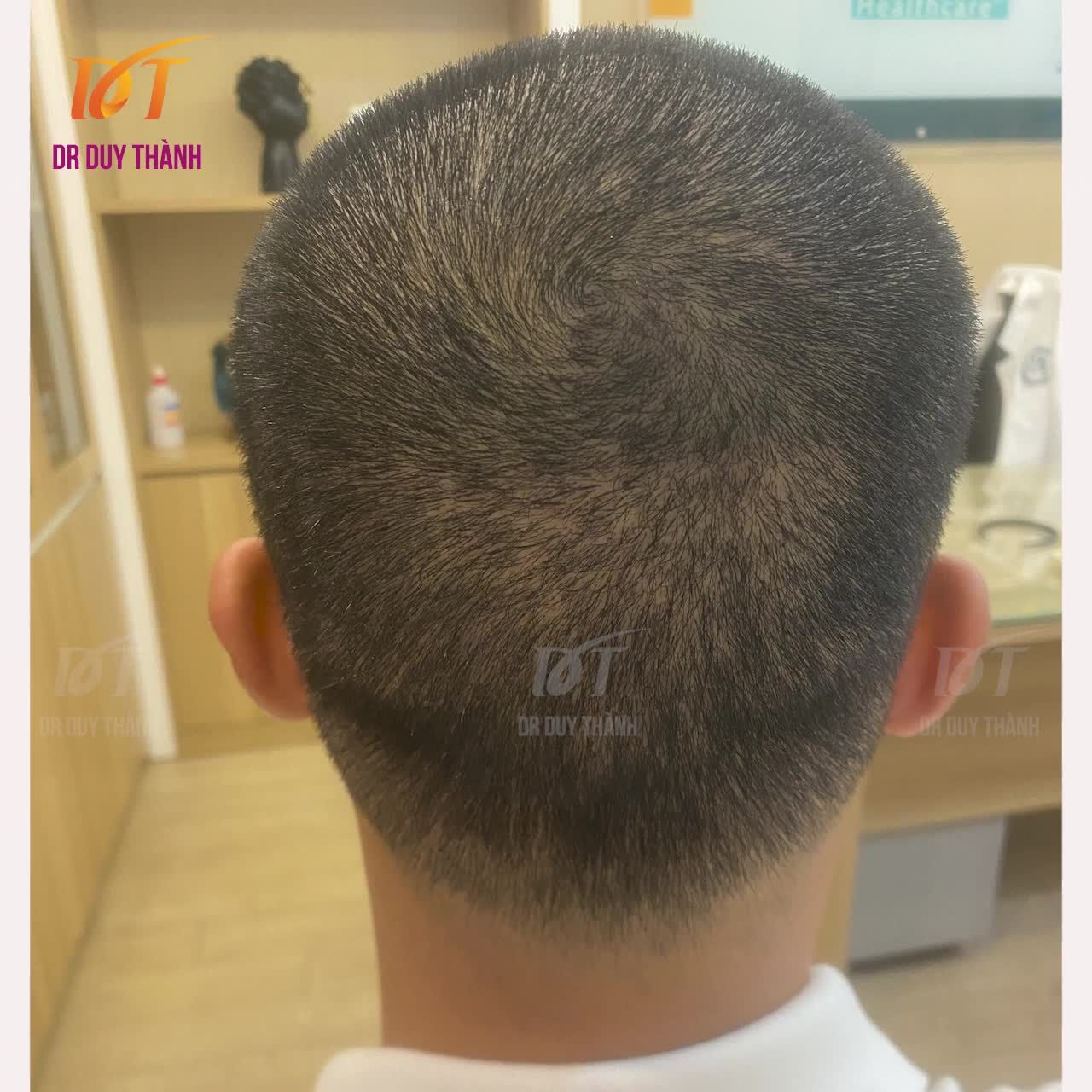 Sau 3 tuần cấy tóc (tính từ thời điểm cấy phiên 1). Phiên 2 cấy sau phiên 1 một tuần.