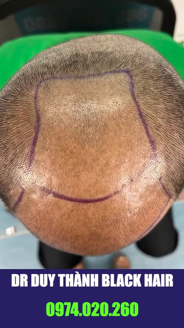 Giành cho những ai muốn cấy tóc tự thân