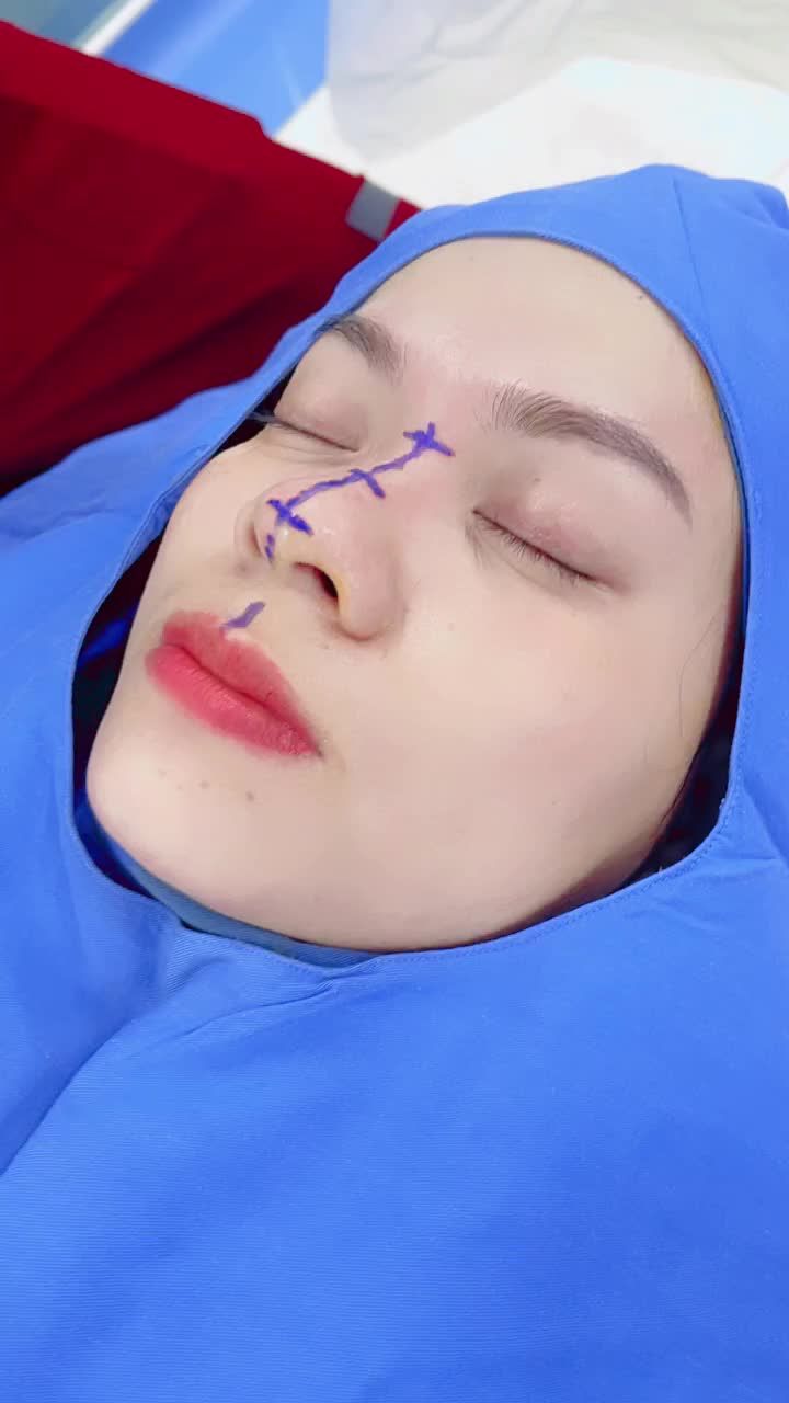 Có chị em nào, nhìn đường kẻ đo vẽ kỹ lưỡng của bác sĩ là muốn đi nâng mũi ngay không!