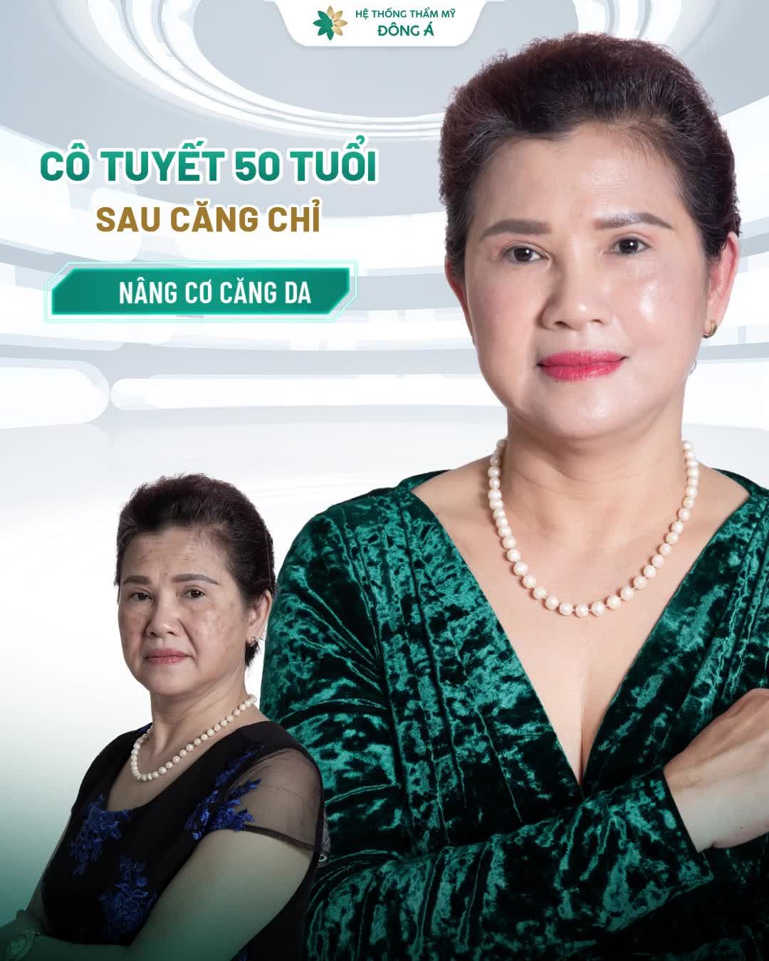 Cô Tuyết (50 tuổi) đã có được tấm vé trở về thanh xuân nhờ CĂNG DA MẶT BẰNG CHỈ THỤY SĨ X-SMART NANOLIFT