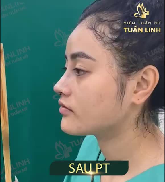 THAY ĐỔI DÁNG MŨI SẼ THAY ĐỔI NHAN SẮC CẢ KHUÔN MẶT BẠN ĐÓ!!!