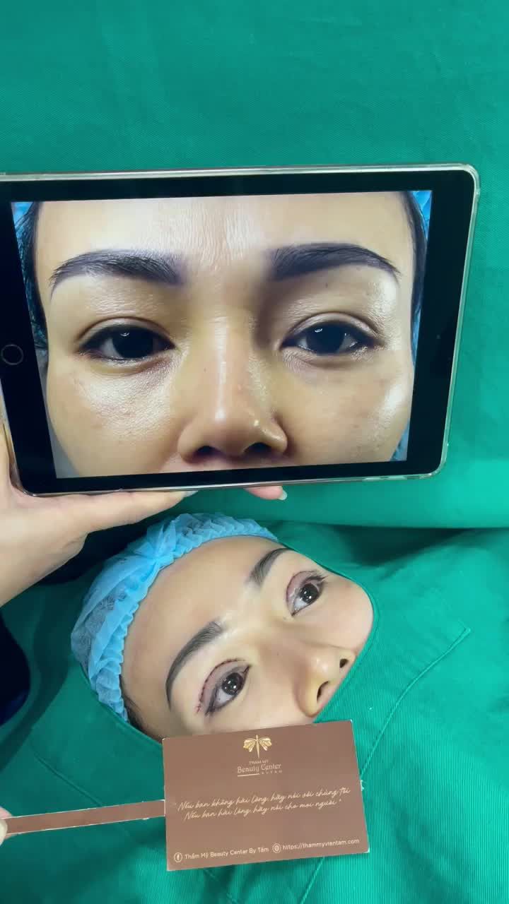 Cắt mí Line Mini loại bỏ mọi nhược điểm da chùng, da dư, mí sụp.