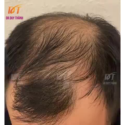 Nghỉ trưa thả nhẹ chiếc video cấy tóc tốn nhiều công lực cho bạn khách đến từ Hải Dương ngày hôm qua.