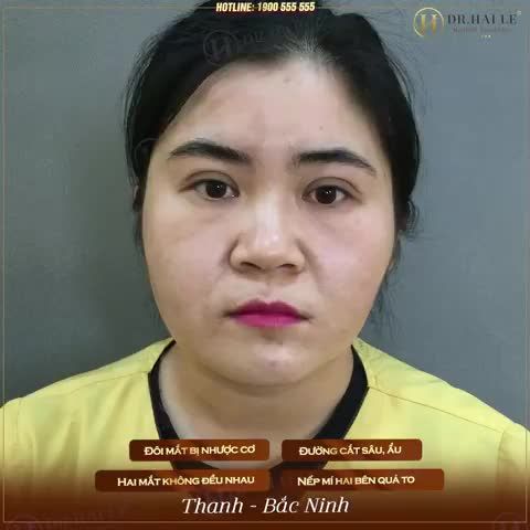 Sửa được mí là NHẸ HẾT CẢ NGƯỜI - Nàng ấy chia sẻ