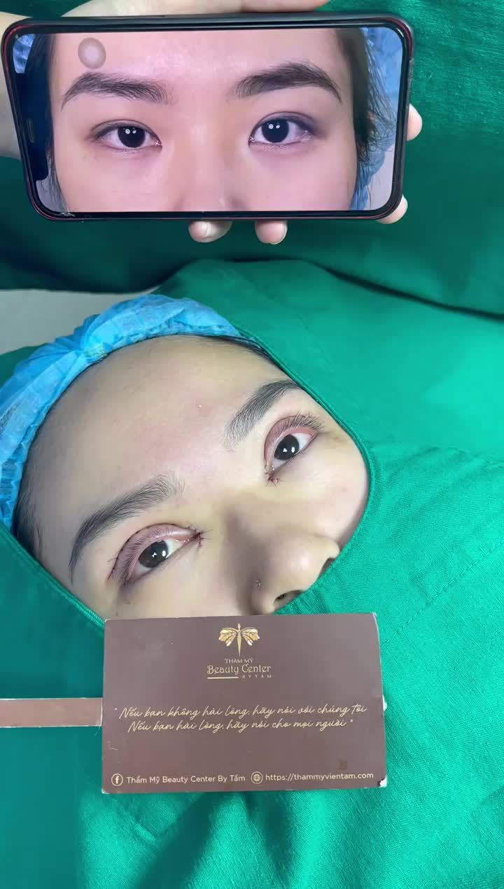 Combo Cắt mí, mở góc trong tại TMV Tấm.