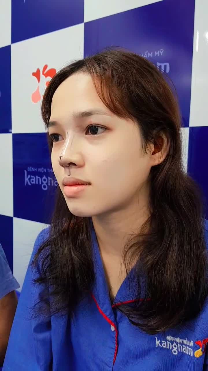 Nữ sinh gen Z biến hình xinh đẹp sau nâng mũi cấu trúc 4D surgiform + chỉnh xương