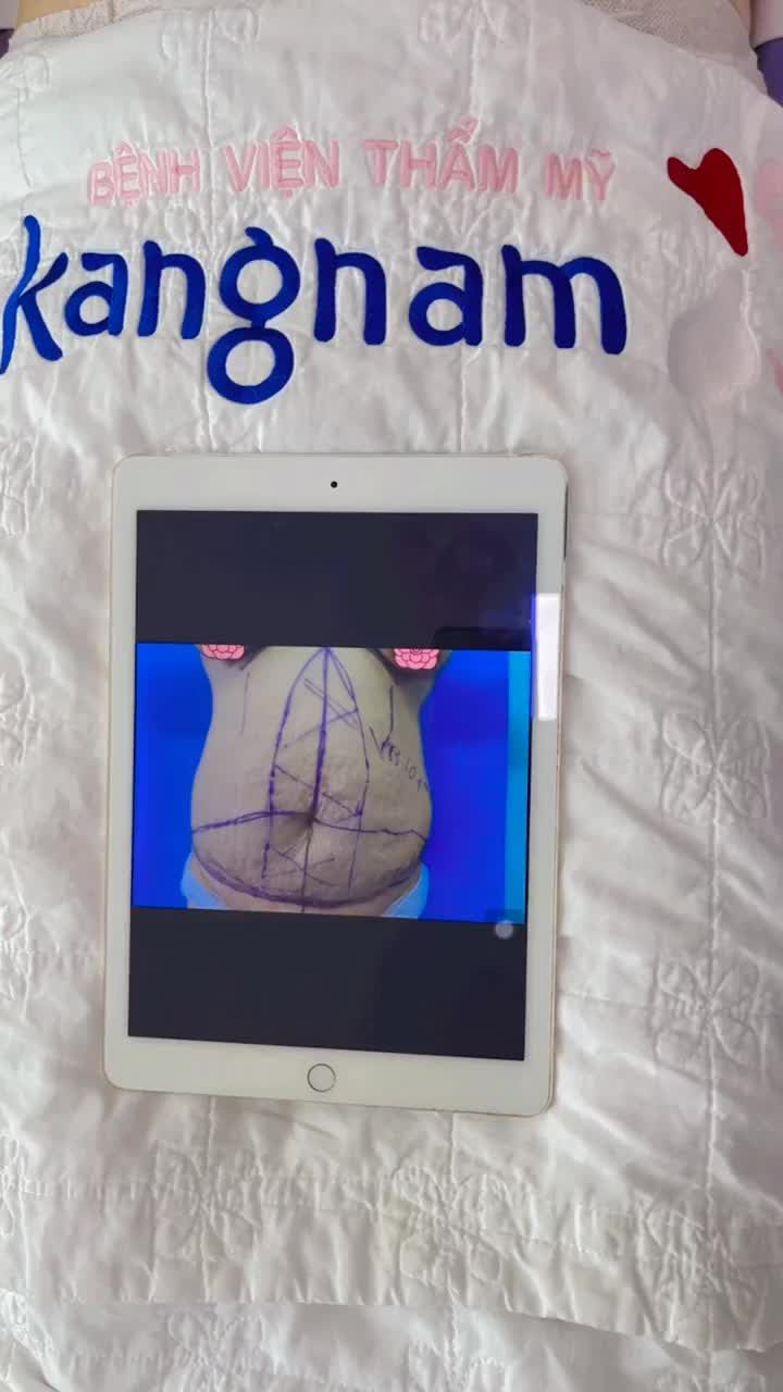 Vòng bụng 104 cm KHÔNG THÀNH VẤN ĐỀ