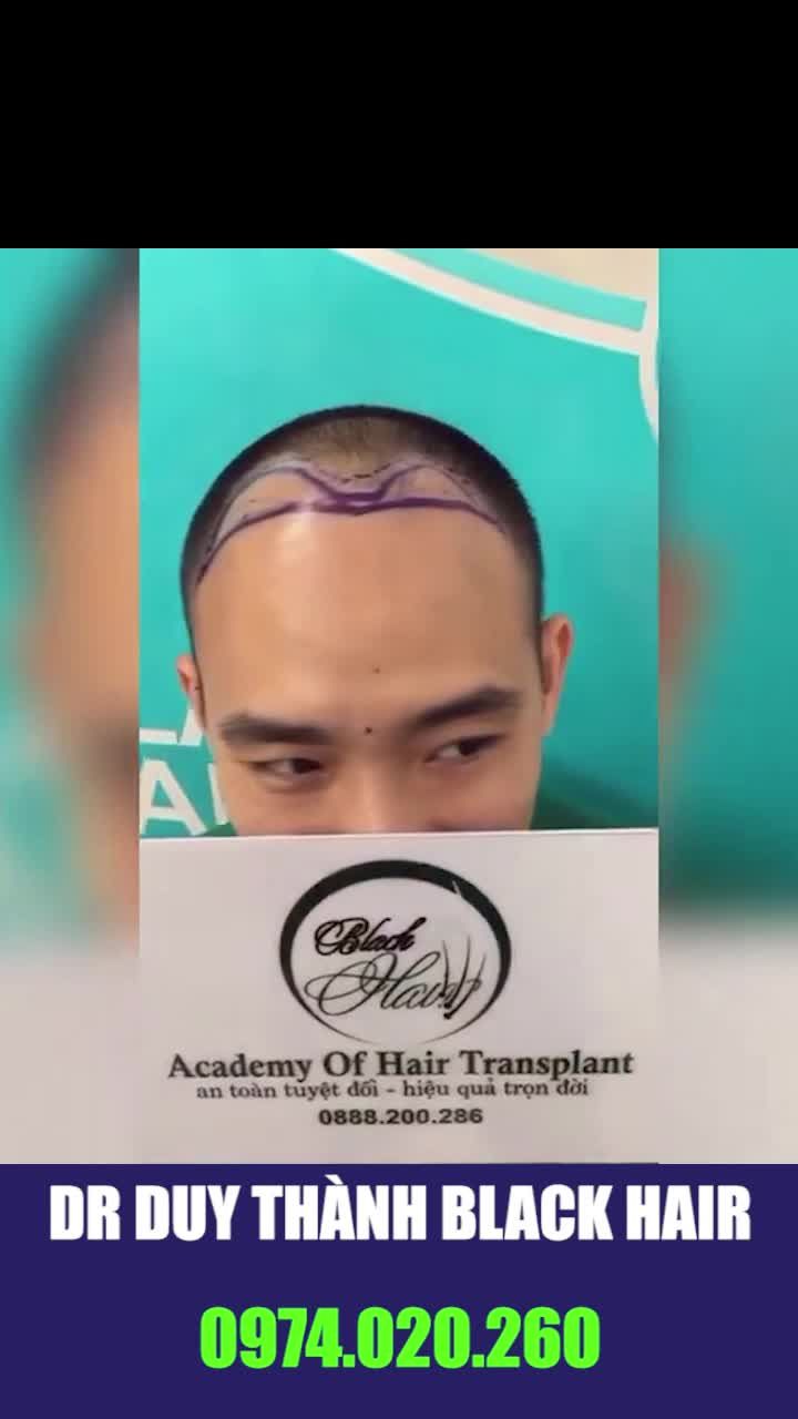 Giải pháp số 1 trong điều trị hói đầu nam giới: cấy tóc