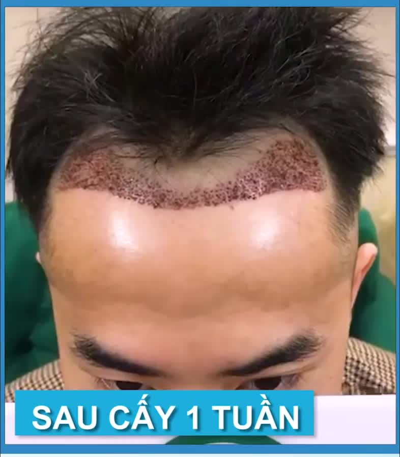 Chiêm ngưỡng sự khác biệt sau 1 năm cấy tóc!
