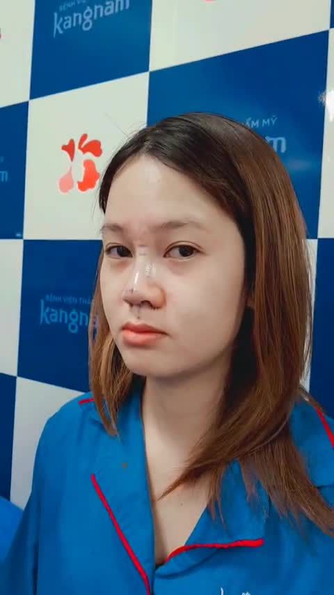 Cận cảnh Nâng mũi 6D thay đổi hoàn toàn ngay khi vừa thực hiện xong