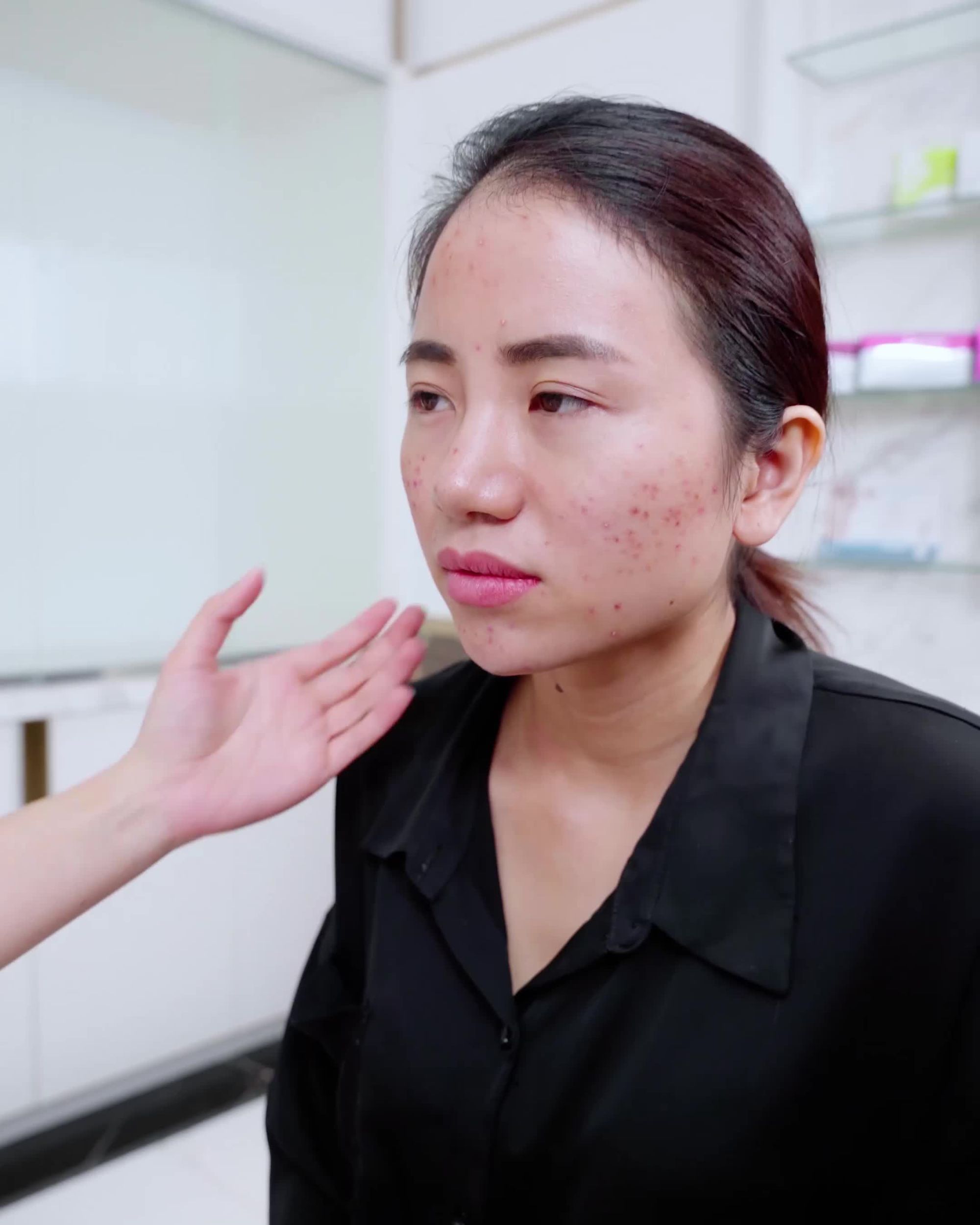 Da mụn tự ti, thâm mụn gây mất thẩm mỹ. Giải pháp nào cho làn da đa khuyết điểm
