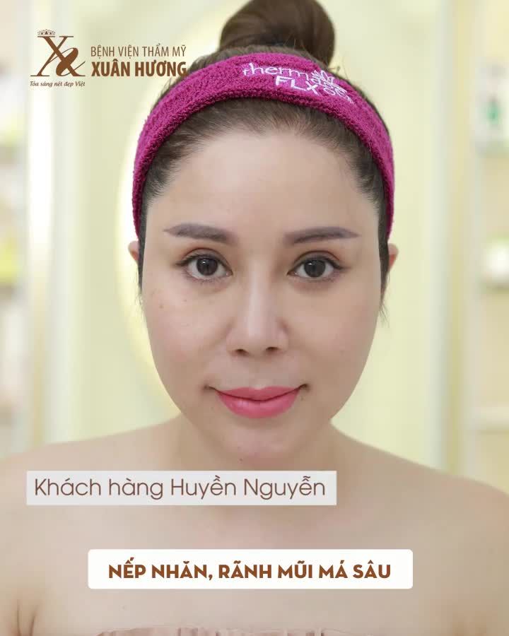 THERMAGE FLX 4.0 - XÓA NHĂN NHANH CHÓNG, TRẺ HÓA TOÀN DIỆN