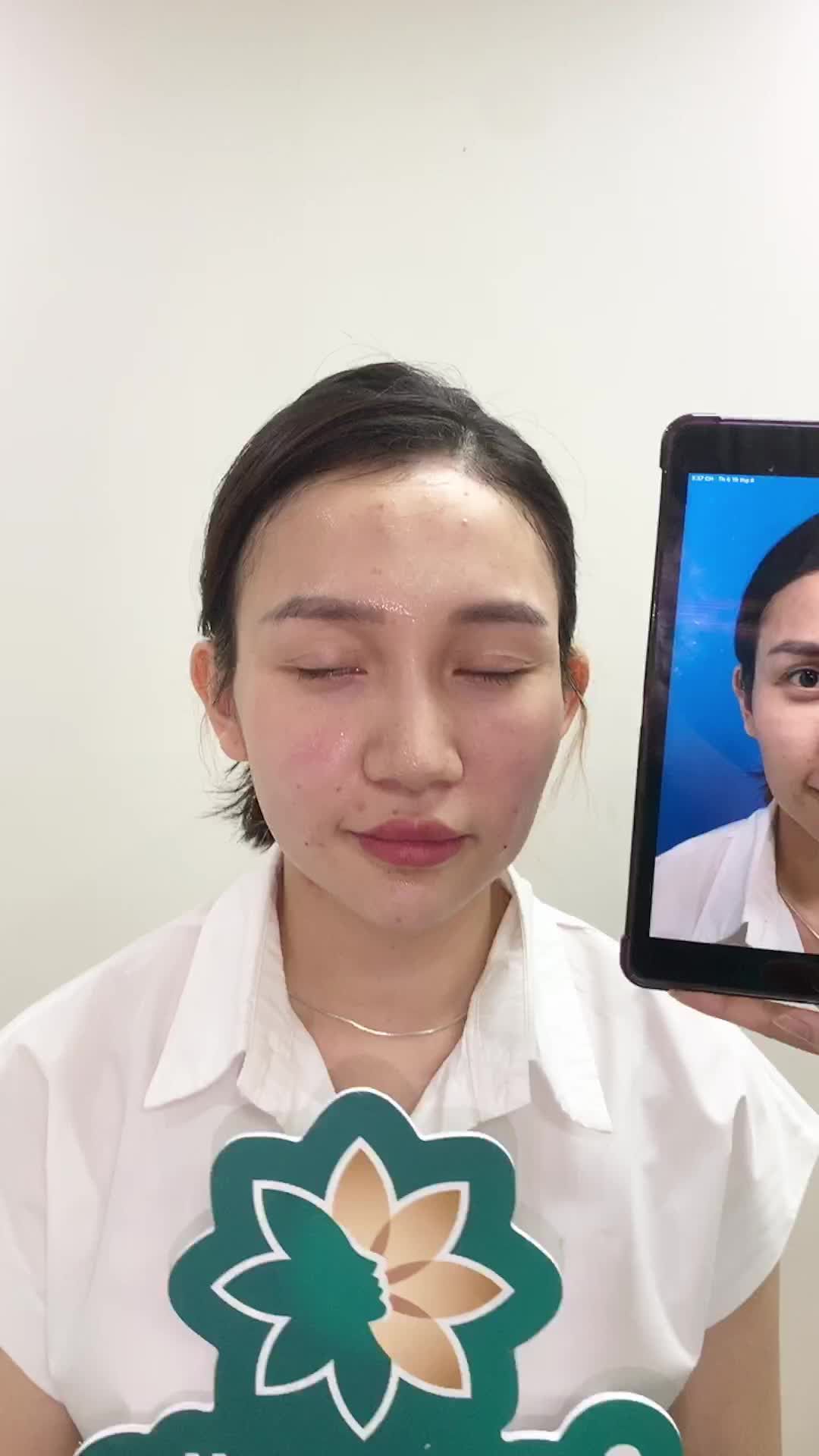 Trẻ ra 10 tuổi nhờ công nghệ NaNo Lift tại Đông Á . Xem ngay !!