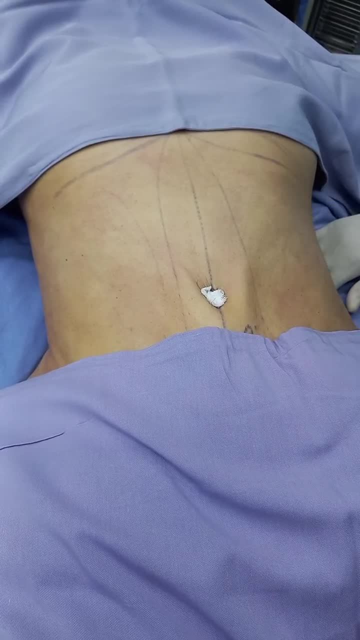 U50 về dáng gọn gàng sau giảm mỡ bụng Vaser 4D