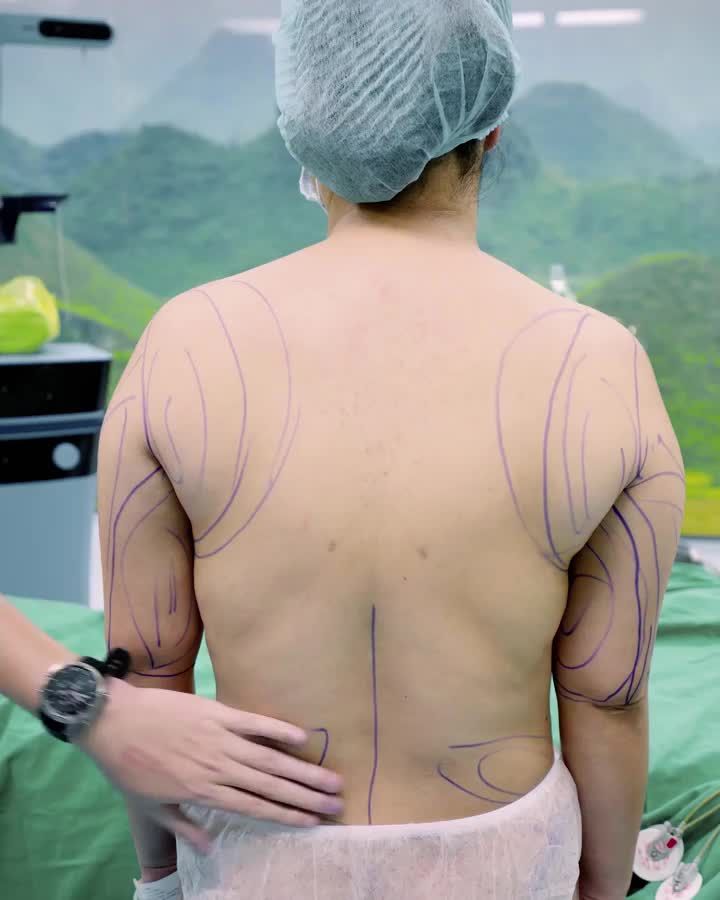 HÚT MỠ CÁNH TAY, VAI, EO - CẤY MỠ M.ÔNG CHO CHỊ KH U40