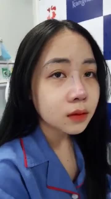 Cận cảnh dáng mũi sau 45 phút Nâng mũi 6D không đau