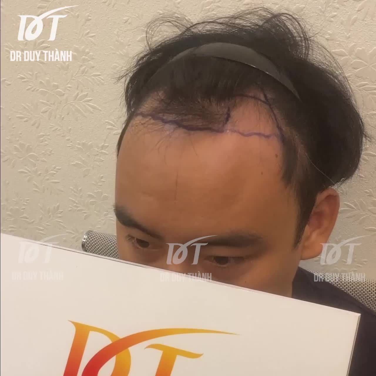 TRƯỚC VÀ NGAY SAU CẤY 1800 NANG TÓC KHẮC PHỤC HÓI CHỮ M.